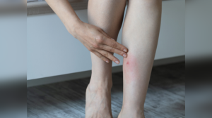 Itch, fever, or worse? Can mosquito bites trigger severe allergic reactions as well?