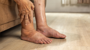 7 Silent Signals of Kidney Damage You Shouldn't Ignore