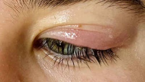 Eyelid problems and disorders explained: Causes, symptoms, and effective treatments