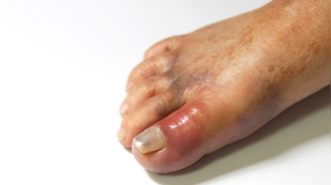 High Uric Acid and Your Skin: Spotting the 5 Warning Signs