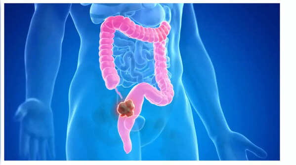 Illustration of rapid and unexplained weight loss.