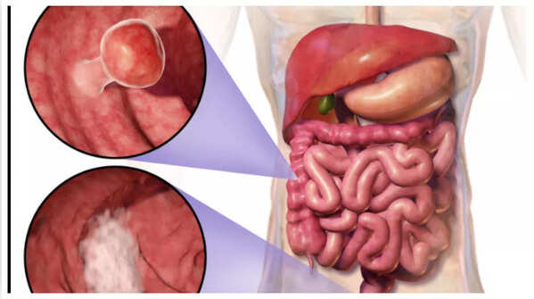 Image depicting blood in stool as a symptom.