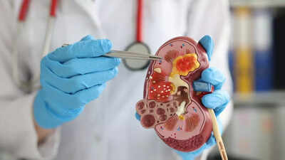 How to prevent kidney stones: Lifestyle changes and diet tips