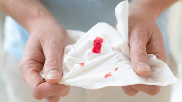 Frequent nosebleeds