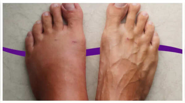 Swelling (Edema)