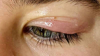 Eyelid problems and disorders explained: Causes, symptoms, and effective treatments