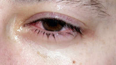 Why do your eyes get crusty in the morning: Causes, treatment, and when to worry