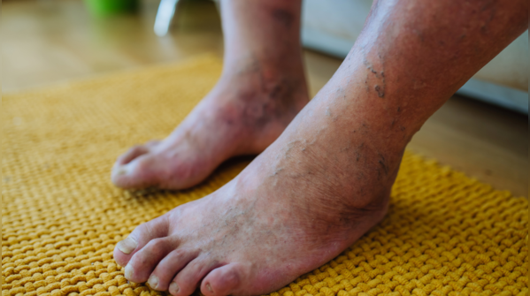 Hyperpigmentation