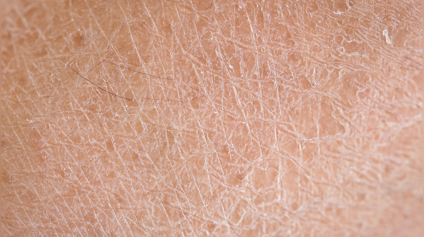 Flaky or peeling skin