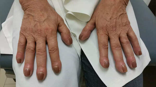 Clubbed fingers