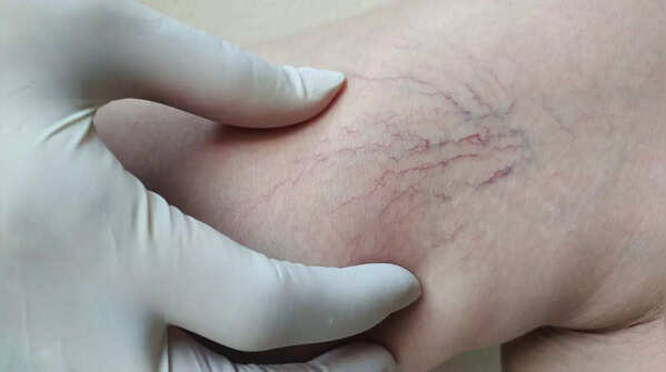 Small visible vessels on skin