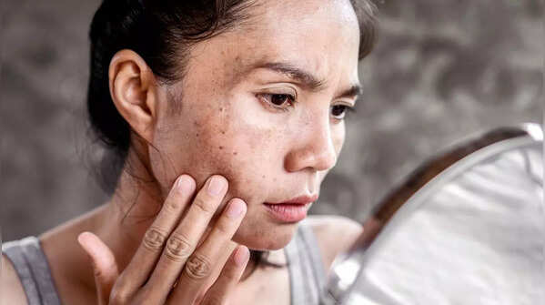Dark patches on skin