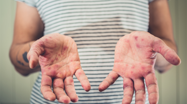Hand, foot, and mouth disease