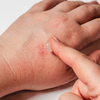 Red or blotchy palms