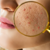 Persistent acne and oily skin