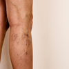 Spider veins or tiny red spots on the skin