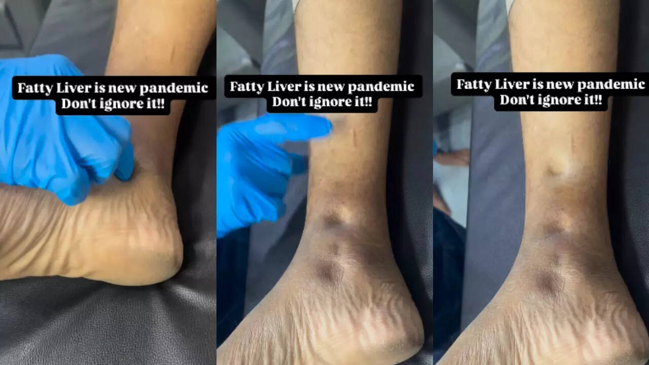 pedal edema